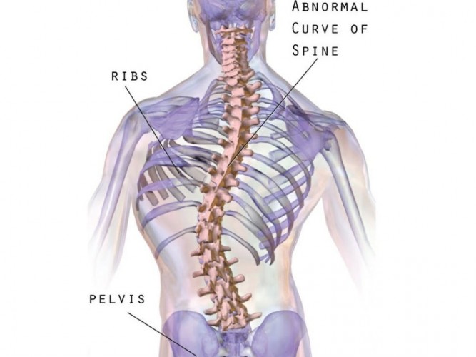 Skolyoz görseli
